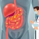 Gastrite Crônica: causas, sintomas e tratamento para aliviar o desconforto